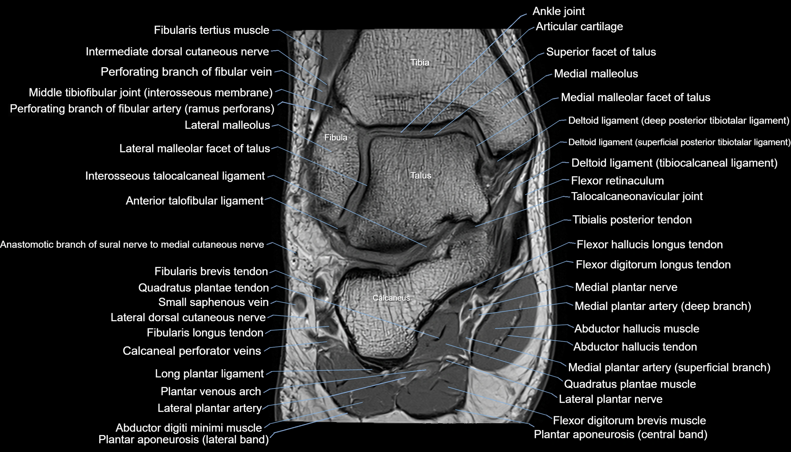 Ankle coronal anatomy 3T MRI images -img-11001-00011.webp